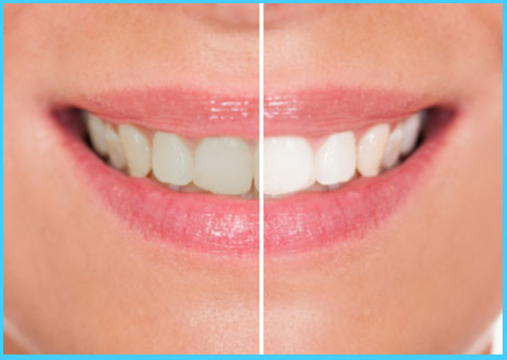 dentist grade teeth whitening gel