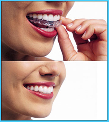 Premium Photo  Alignment of crooked teeth with the help of braces